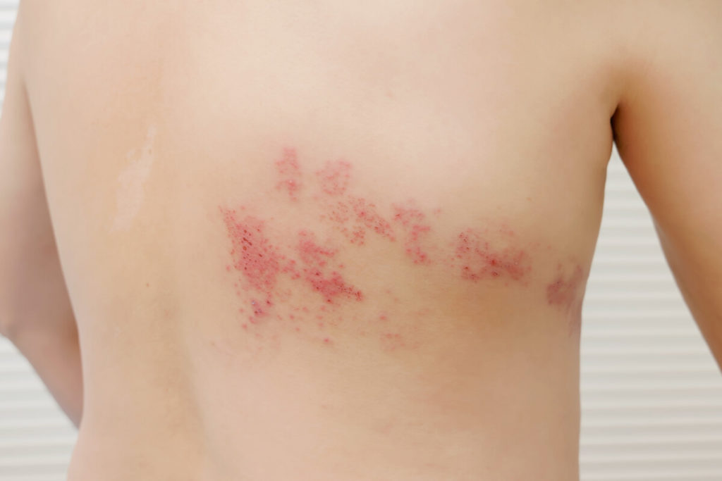 Shingles and Acupuncture Treatment